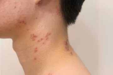 shingles rash with red blisters on skin