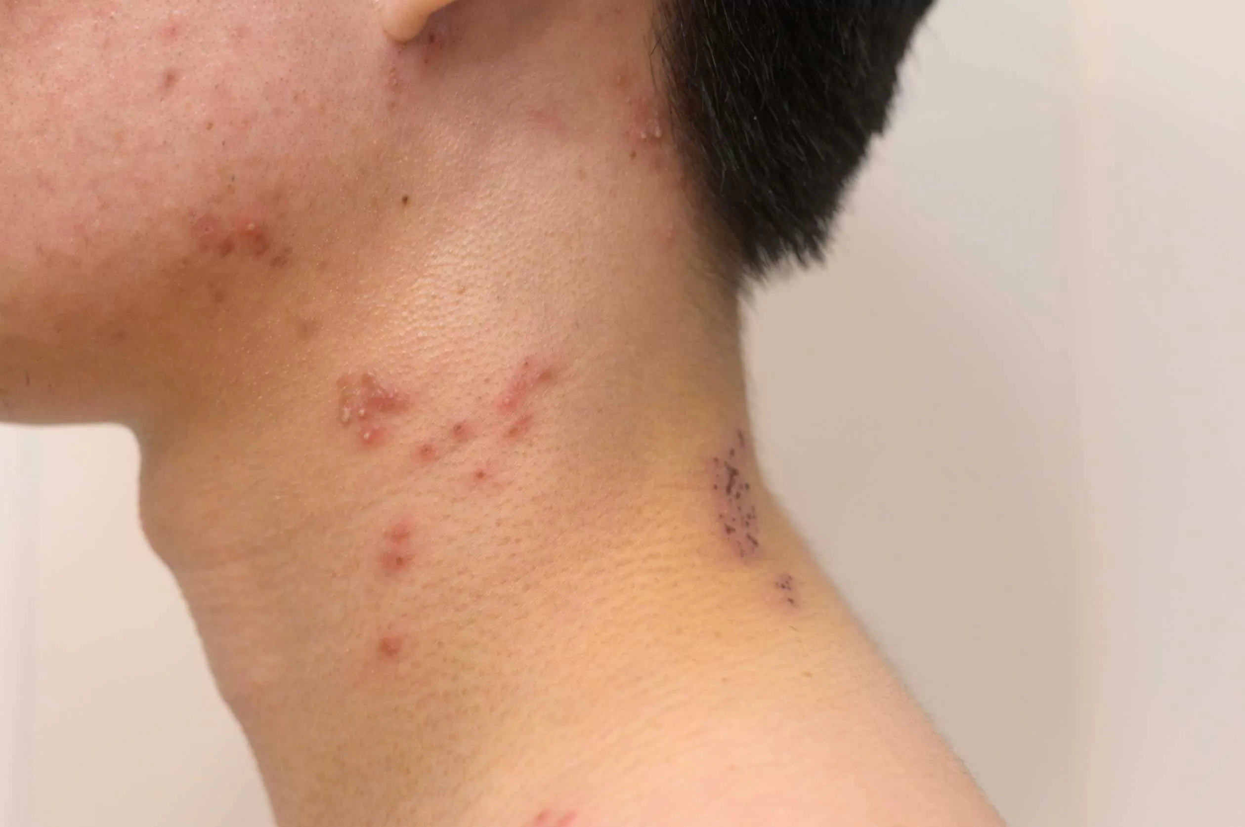 Shingles-rash-with-red-blisters-on-skin