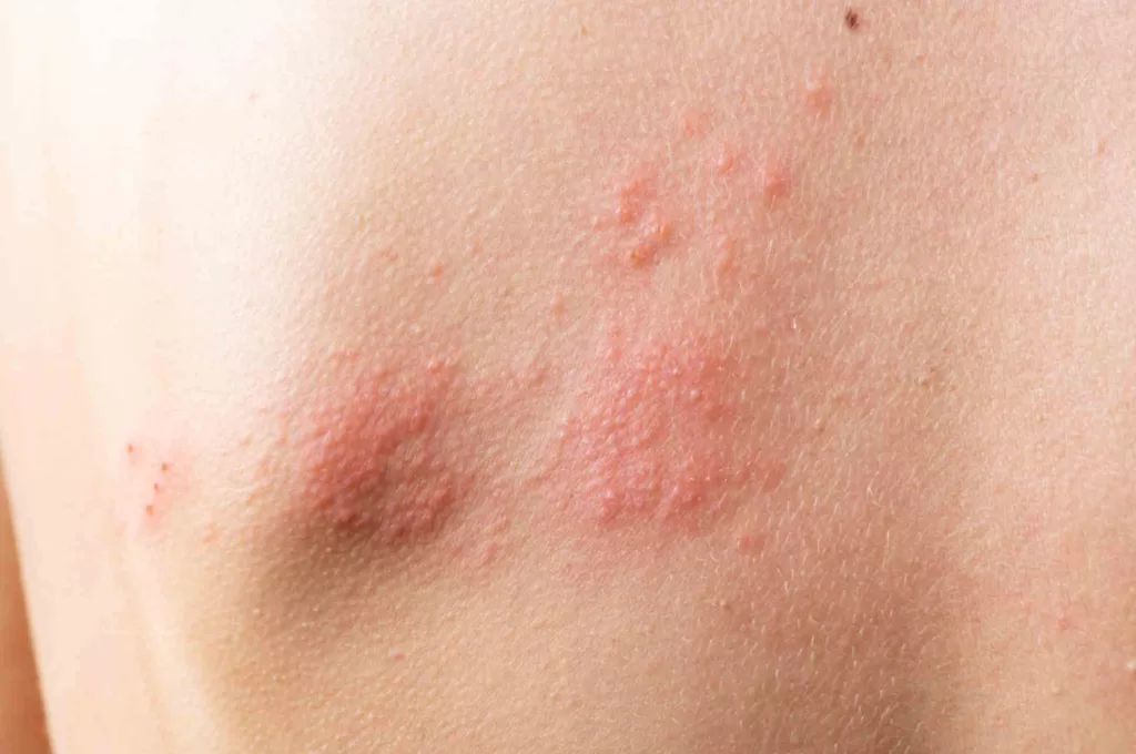 shingles pain relief treatments