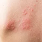shingles pain relief treatments