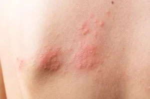 shingles pain relief treatments