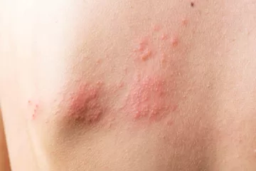 shingles pain relief treatments