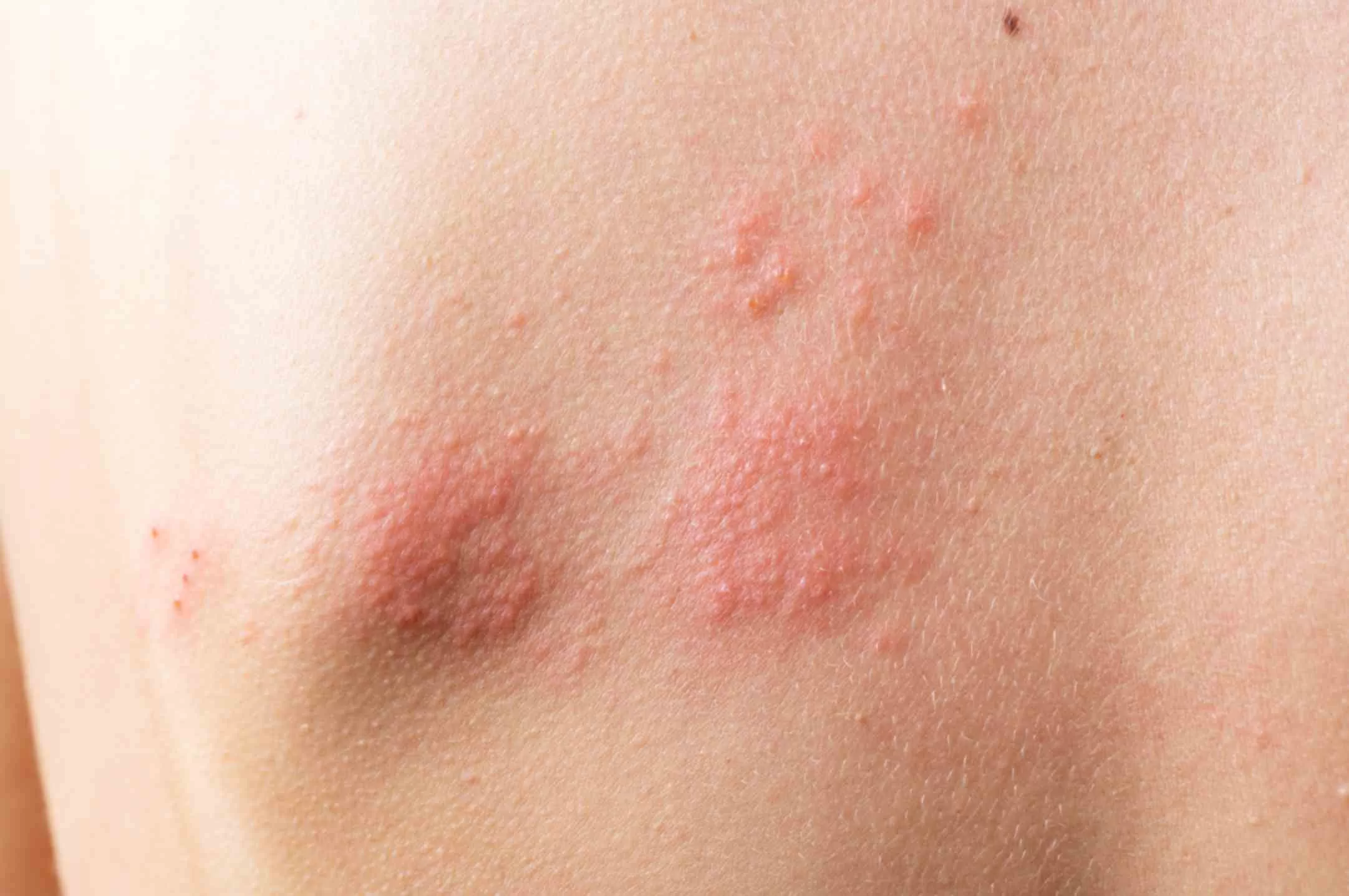 Shingles-pain-relief-treatments