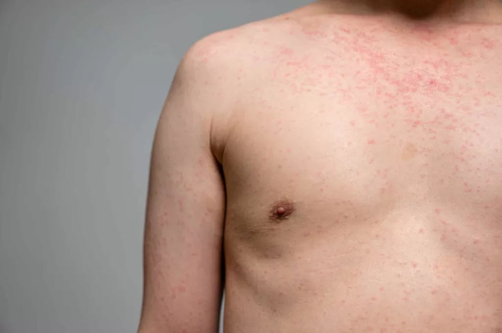 difference between measles and chickenpox