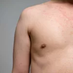 difference between measles and chickenpox