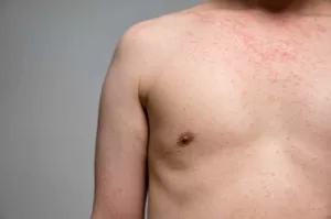difference between measles and chickenpox