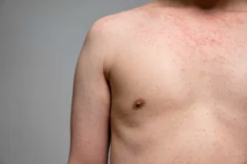 difference between measles and chickenpox