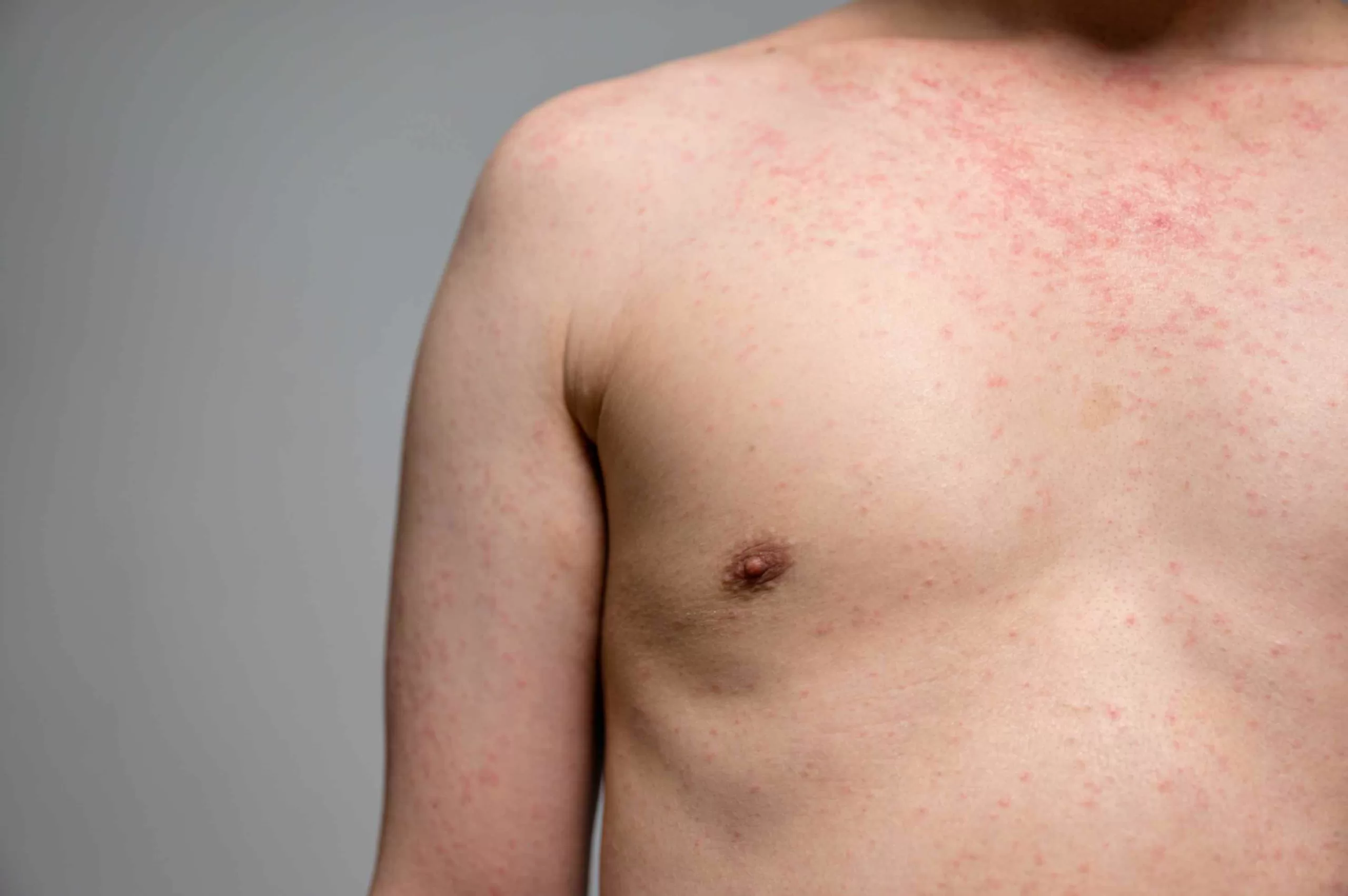 Difference-between-measles-and-chickenpox