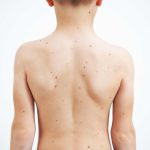 bathing safely during chickenpox infection