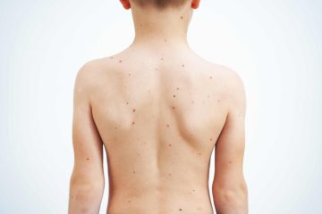 bathing safely during chickenpox infection