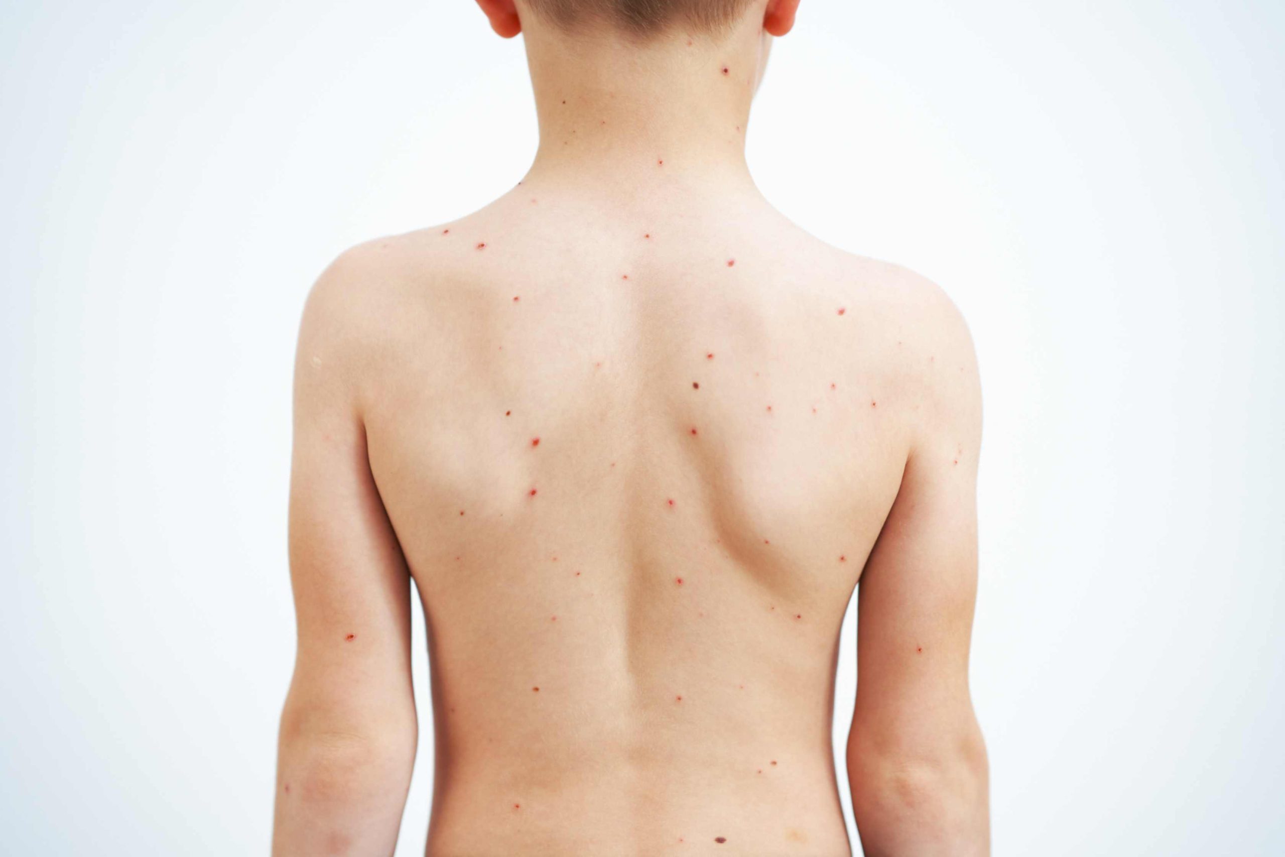 bathing-safely-during-chickenpox-infection