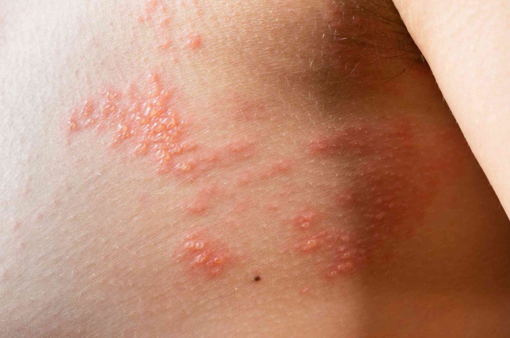 how the shingles vaccine helps prevent shingles