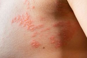 how the shingles vaccine helps prevent shingles