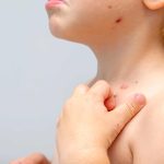 chickenpox symptoms risks and prevention in adults