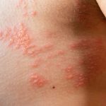 what are the early signs of a shingles rash