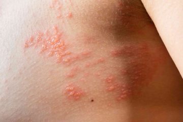 what are the early signs of a shingles rash