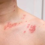 what does a shingles rash look like in its first stages
