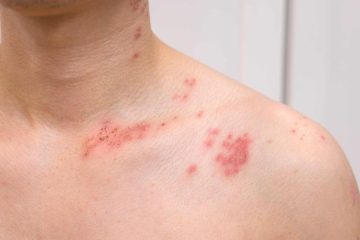 what does a shingles rash look like in its first stages