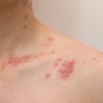 shingles symptoms and how long they last