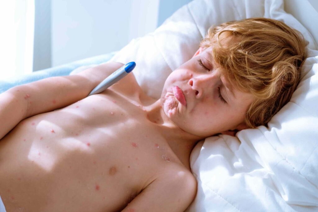 chickenpox vaccination for adults who never had it