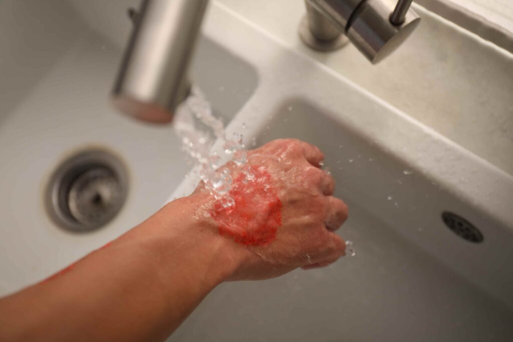 why wash an animal bite immediately