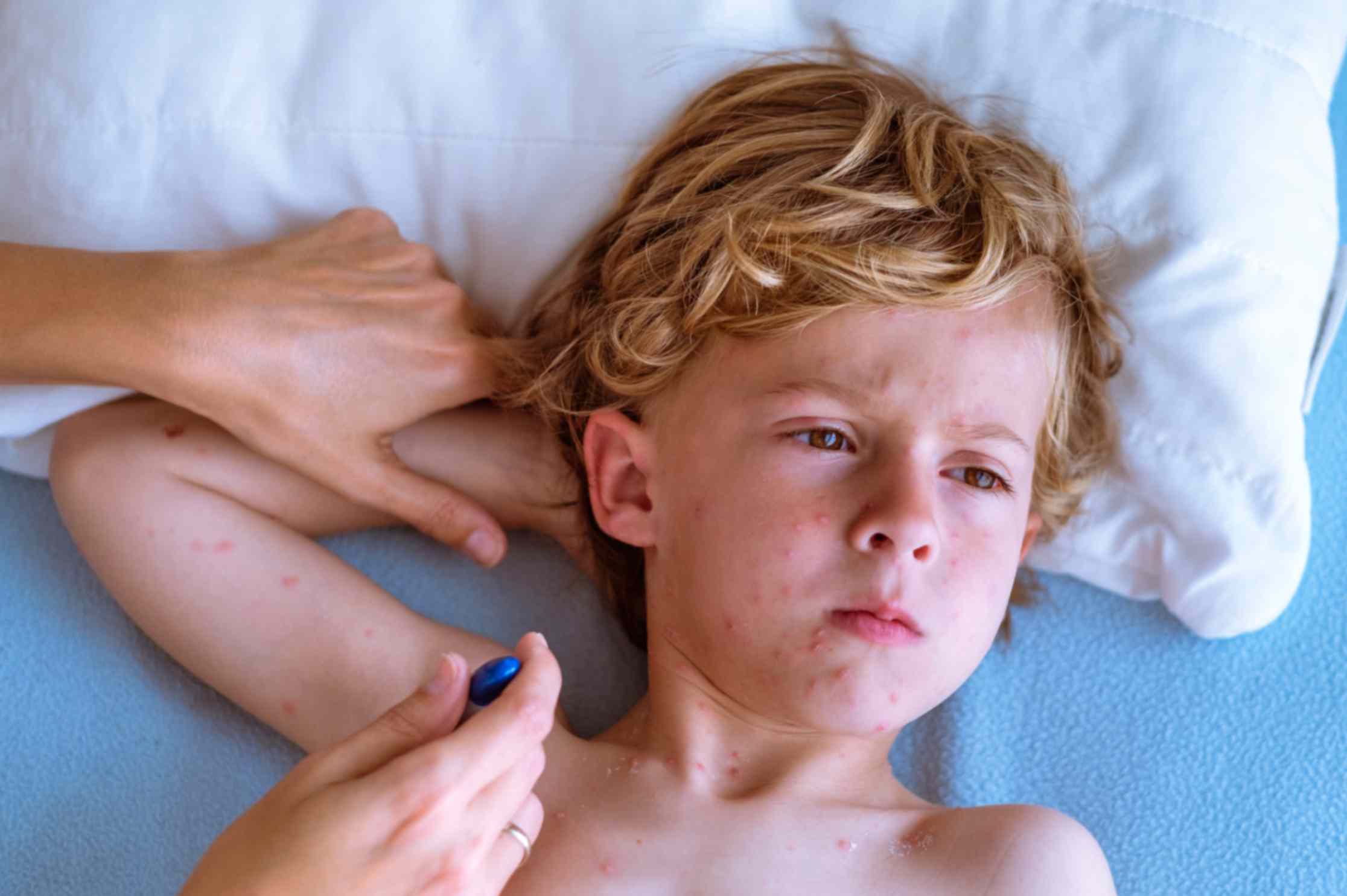 chickenpox-vaccine-and-shingles-risk-later-in-life